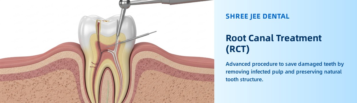root canal treatment kishangarh